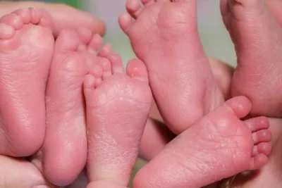 Bayi Kembar 9 Pertama di Dunia Rayakan Ulang Tahun Kelima
