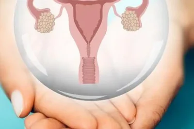 Dokter Spesialis Jelaskan Penanganan Kista Ovarium Tanpa Operasi