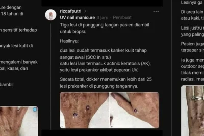 Rutin Pakai UV Nail Lamp, Wanita 52 Tahun Kena Kanker Kulit