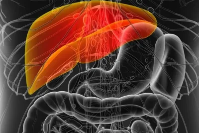 Kenali Gejala Liver Bermasalah dan Tahapan Perkembangannya